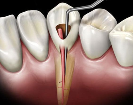 Understanding the Root Canal Process